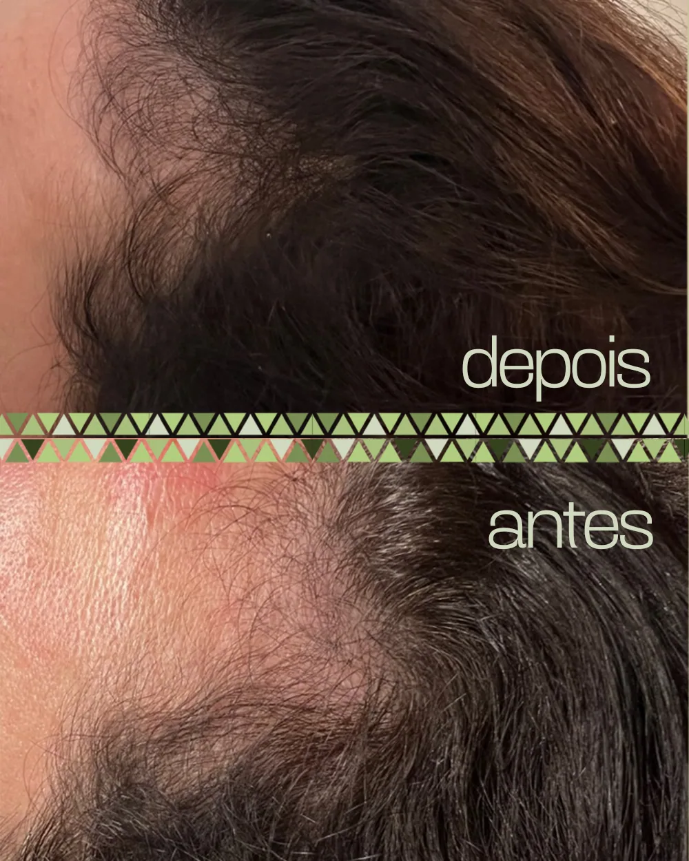 Antes e depois da linha frontal do cabelo, em close, com o depois acima e o antes abaixo.