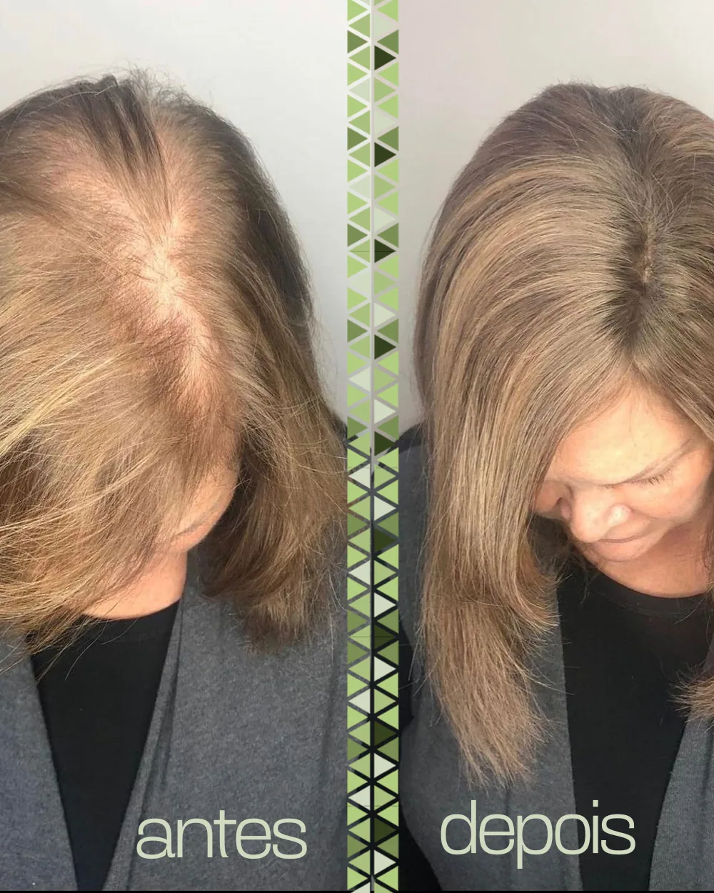 Antes e depois do topo da cabeça, lado a lado, mostrando a coroa mais preenchida.
